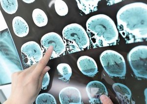 Alzheimer xəstəliyinin çarəsi tapıldı - YENİ KƏŞF