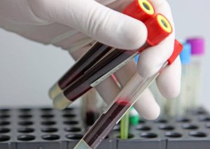 Azərbaycanda qeydiyyatda olan hemofiliyalı xəstələrin SAYI açıqlandı