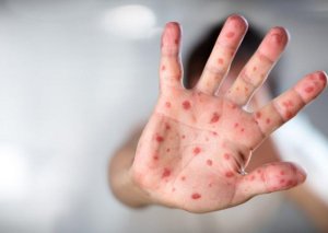 ÜST-dən həyəcan siqnalı! Qızılca tüğyan edir