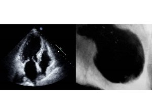 Azərbaycanda 61 yaşlı qadında nadir ürək xəstəliyi aşkarlanıb