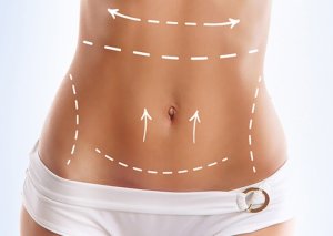 Qarın dartdırma əməliyyatı nədir?