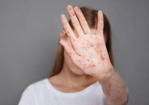 ÜST-dən xəbərdarlıq: Fırtınadan əvvəlki sakitlikdir, daha bir qorxulu epidemiya gəlir
