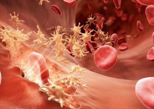 Azərbaycanda hemofiliya xəstələrinin sayı açıqlanıb