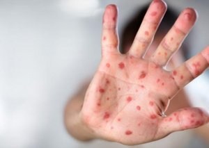 Ölkədə üç virus tüğyan edir - hepatit A, qızılca, suçiçəyi...