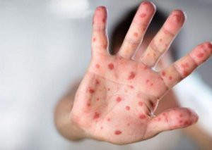 ÜST-dən qlobal qızılca təhlükəsi ilə bağlı XƏBƏRDARLIQ