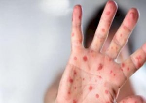 13 mindən çox uşaq qızılcaya yoluxub - Rəsmi