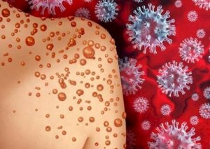 Azərbaycanlı alimdən “Meymun çiçəyi“ ilə bağlı AÇIQLAMA