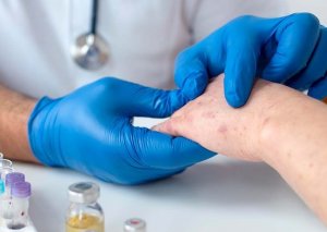 Azərbaycanda meymunçiçəyinə yoluxma qeydə alınıb?