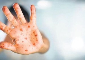 Azərbaycanda meymunçiçəyi virusuna ilk yoluxma faktı aşkarlanıb - RƏSMİ