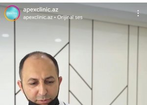 "Apex Clinic"də azyaşlının alveol sümüyü zədələndi - Baş həkim Əli Əliyev 20 min cərimələndi