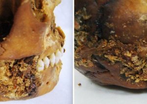 Qədim insanlar çənə üzərində mürəkkəb əməliyyatlar aparırmış —